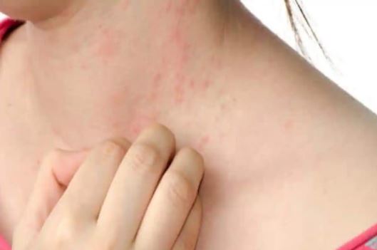 CBD against skin rashes