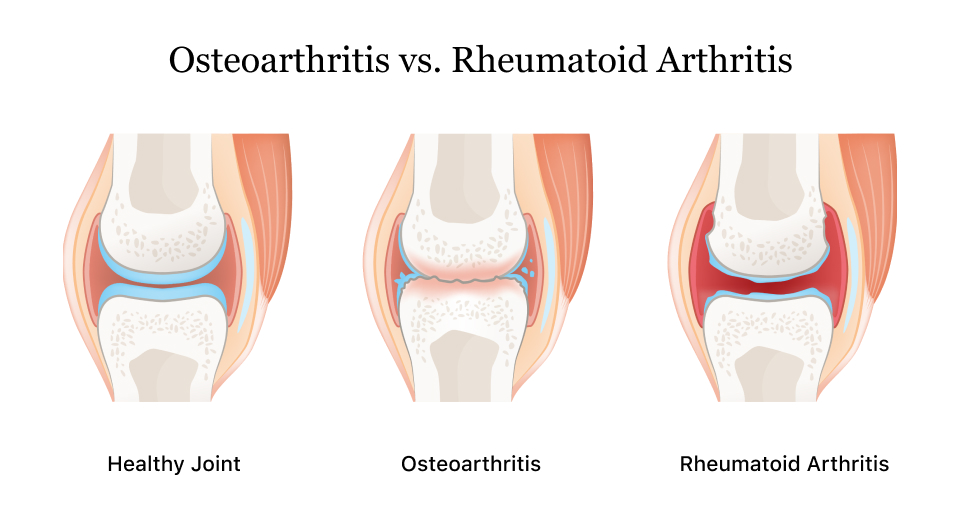 Delta 8 for Arthritis and Osteoarthritis